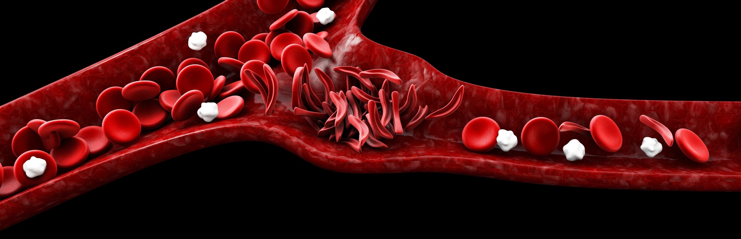 Sickle cell anemia, 3D illustration showing blood vessel with normal and deformed crescent