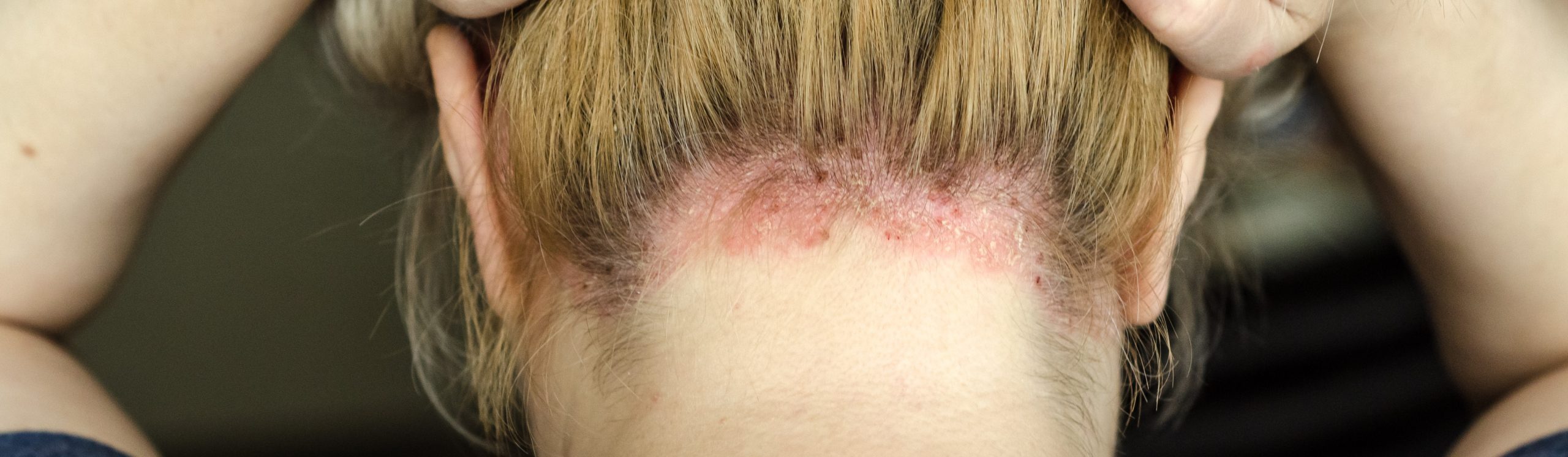 Łuszczyca skóry głowy