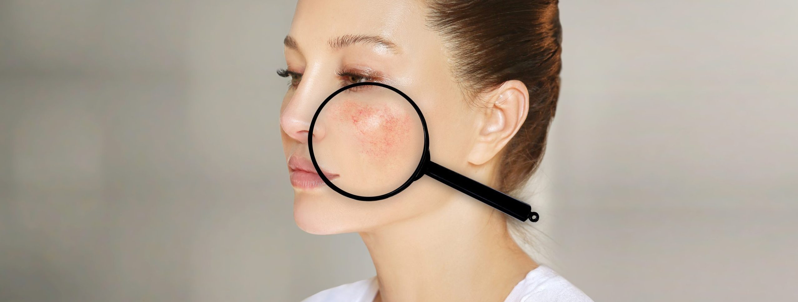 Toczeń rumieniowaty