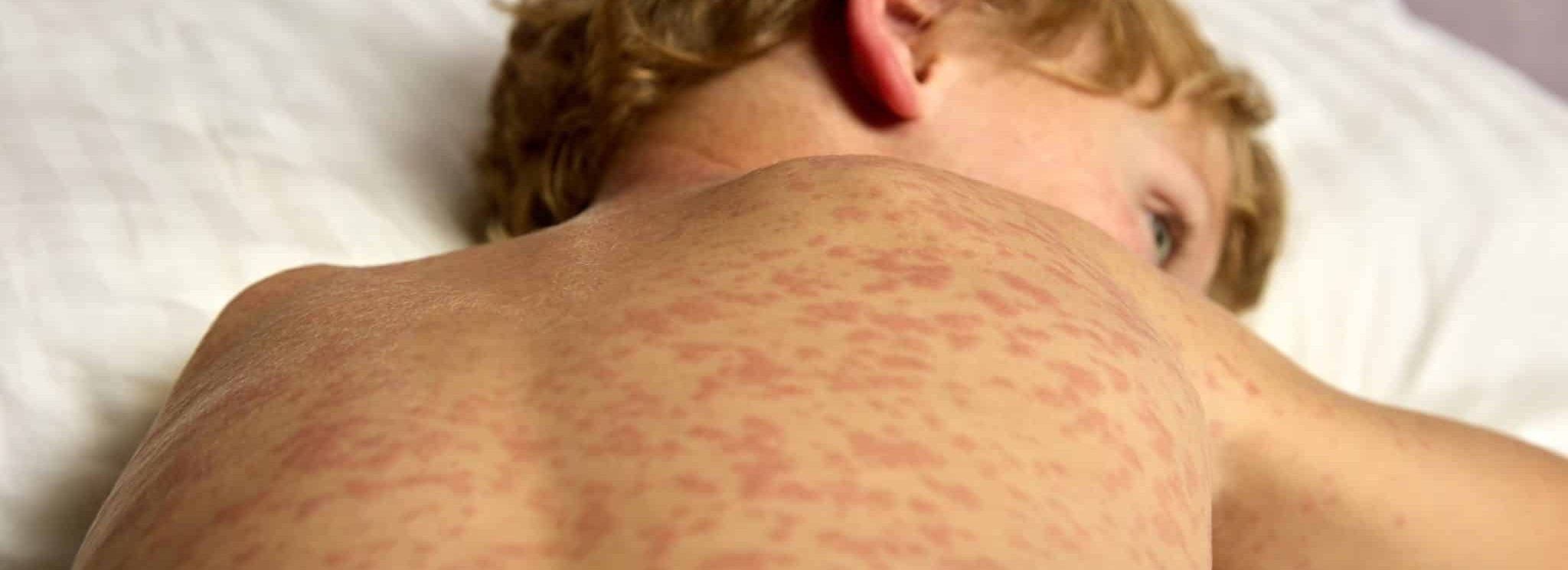 Czym jest półpasiec