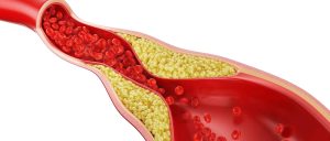 Hipercholesterolemia