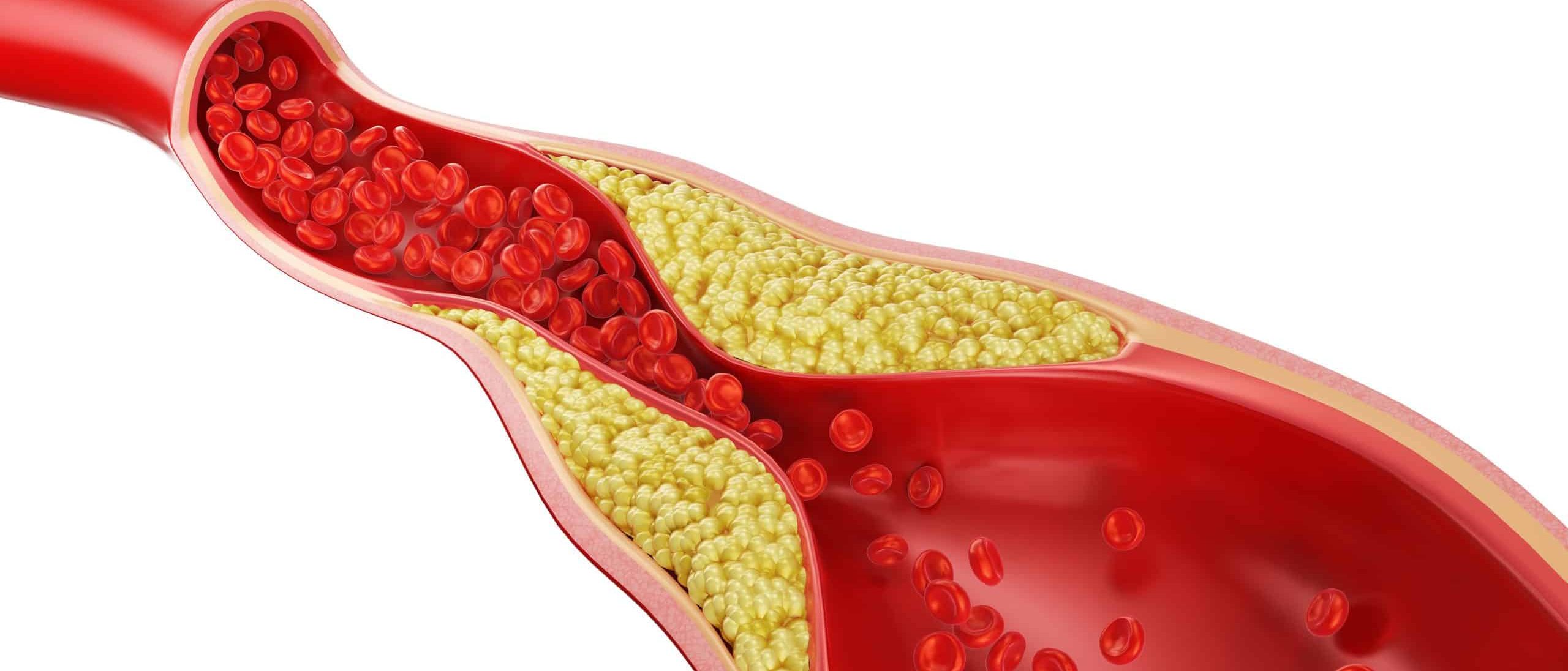 Hipercholesterolemia