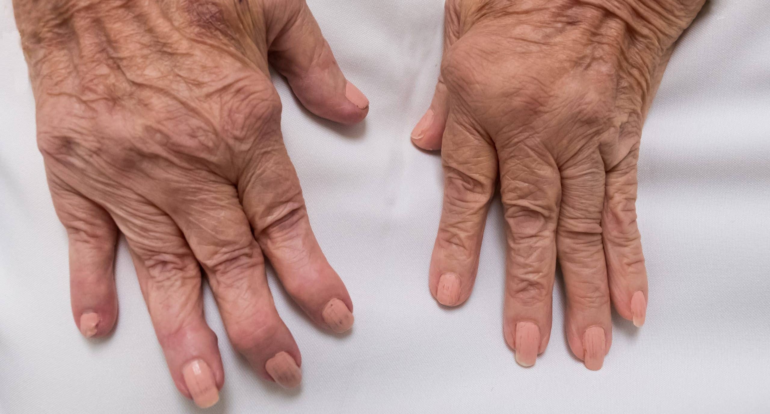 Reumatoidalne zapalenie stawów