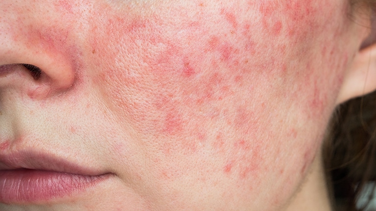 2025 04 17 Synevo produktowe 768x432px nuzeniec